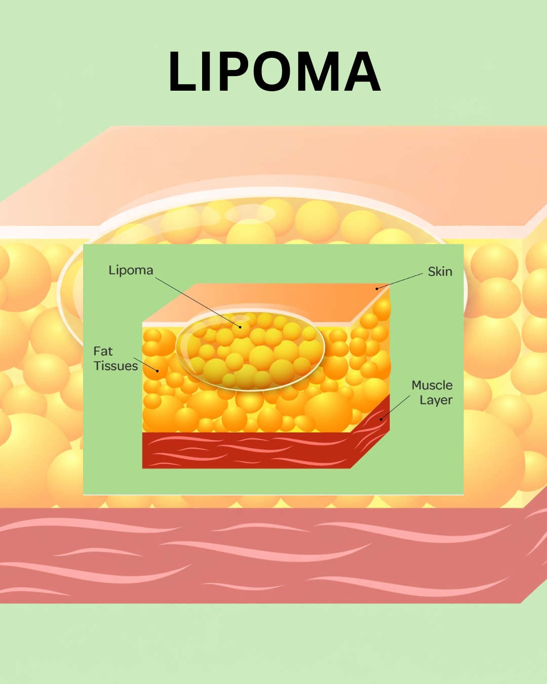 Lipoma anatomical illustration